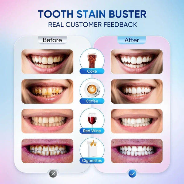 bodyaccel Whitening Toothpaste™ in 1 week